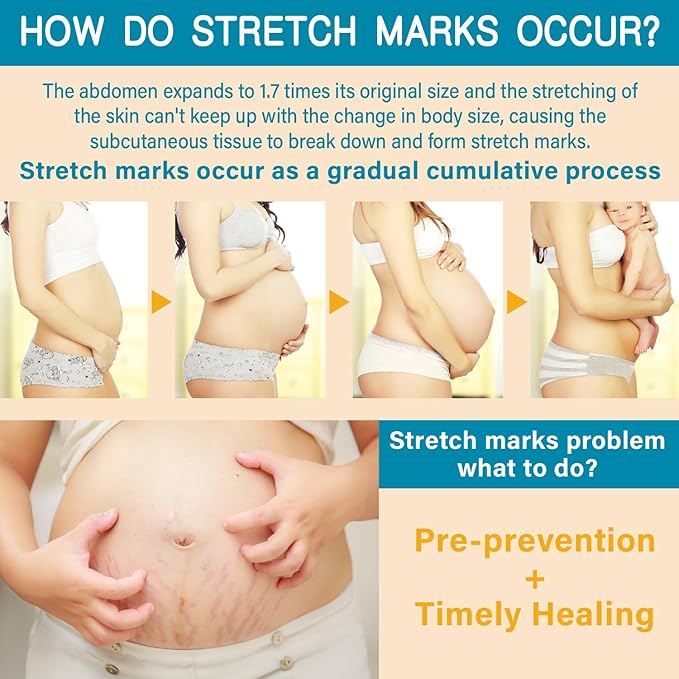 PEGO Stretch Mark Oil for Pregnancy, Maternity Body Oil for Stretch Mark Prevention & Reduction, Hydrating Skin Care, 5.41oz (Oil+Cream)