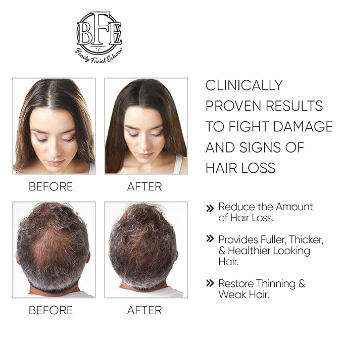 Hair Growth Serum- Maximum Strength DHT Blocker. Repairs & Stimulates New Follicle Hair Growth. Grow Stronger, Thicker, Fuller, Longer, Healthier Looking Hair. For Men & Women with No Side Effects.