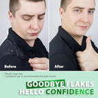 Antifungal Shampoo for Folliculitis and Seborrheic Dermatitis: Scalp Psoriasis Treatment, Dandruff & Itchy Scalp Relief with Salicylic Acid, Piroctone Olamine, Rosemary & Coconut Oil 8.8 fl.oz