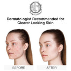 Acne Treatment Pads- Eliminates Cystic Breakouts, Oily Skin & Clogged Pores. Clear Pimple, Whitehead, Blackhead, Dark Spots & Improve Skin Texture.