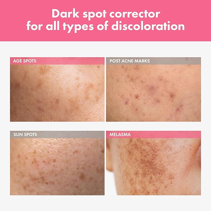 TOSOWOONG Arbutin 7% Intensive Spot Cream with 70,000ppm Arbutin, 3% Tranexamic Acid, 1% Niacinamide, Glutathione, Dark Spots, freckle, Blemishes, Anti-pigmentation, Korean Skin Care, 20ml, 0.67 fl.oz