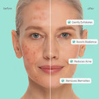 MAREE Azelaic Acid Acne Clearing Pads – Exfoliating Pads with Glycolic & Hyaluronic Acid for Face – 10% Azalecic Acid & Centella Redness Soothing Pad – Zero Pore Facial Toner Pad – Acido Azelaico