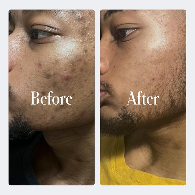 Geologie Complete Skincare Set for Men & Women | 3-Month Simple & Effective Daily Clear Skin Routine | Acne, Oily Skin, Dark Spots | Face Wash 2-Pack, Retinol Face Cream, SPF15 Moisturizer & Eye Cream