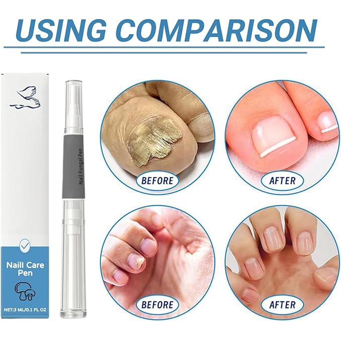 2Pcs Orvalle Nail Fungus Pen, Nail Growth Treatment Repair Serum Twist Pen Activator for Repair & Strengthener, Easy to Apply