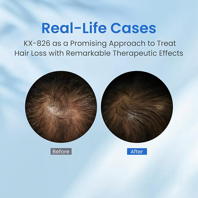 0.5% KX-826 Hair Growth Spray DHT Blocker Hair Thickening Regrowth Treatments,Oil Control Hair Loss Reduction 3-6 Months New Hair Visible,Hair Growth Products Men&Women-4 Month Supply 360ml