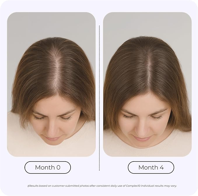 Complex10 Hair Support Supplement with Biotin, Collagen & 10 Essential Nutrients – Supports Healthy, Stronger-Looking Hair – 30 Capsules for Men & Women