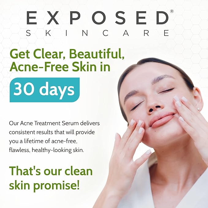 Exposed Skin Care, Acne Treatment Serum with 3.5% Benzoyl Peroxide – Lightweight Acne Spot Treatment – Quickly Clear Teen, Adult, Hormonal and Cystic Acne – Natural, Non-toxic and Cruelty Free