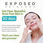 Exposed Skin Care, Acne Treatment Serum with 3.5% Benzoyl Peroxide – Lightweight Acne Spot Treatment – Quickly Clear Teen, Adult, Hormonal and Cystic Acne – Natural, Non-toxic and Cruelty Free