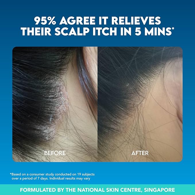 Suu Balm Dry Scalp Treatment, Rapid Itch Relief Anti-Dandruff Scalp Spray Moisturizer, Cooling Itchy Scalp Treatment for Flaky Sensitive & Psoriasis, Cooling Menthol & 5 Ceramides, 1.35 fl oz