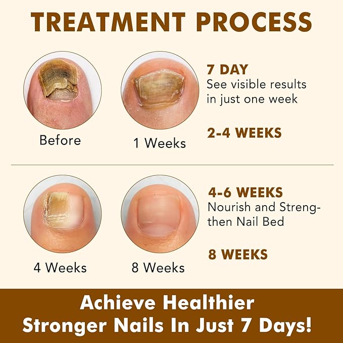 2PCS Ginger Nail Treatment, Nails Growth Serum, Nail Repair Cuticles Oil, Ginger Nail Serum Oil for Strengthen nails & Promote Nail Growth, Natural Plant Formula