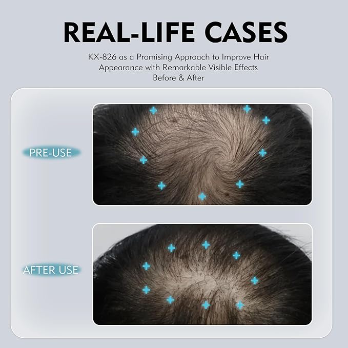 KINTOR 0.5% KX-826 DHT Blocker Hair Regrowth Spray for Men & Women 60ml