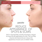 PURA D'OR ORGANIC Rosehip Seed Oil Hair Relaxer (4 Oz x3 = 12 Oz) 100% Pure Cold Pressed USDA Certified All Natural Anti-Aging, Scar Treatment, Gua Sha Massage, Face, Hair & Skin - Women & Men