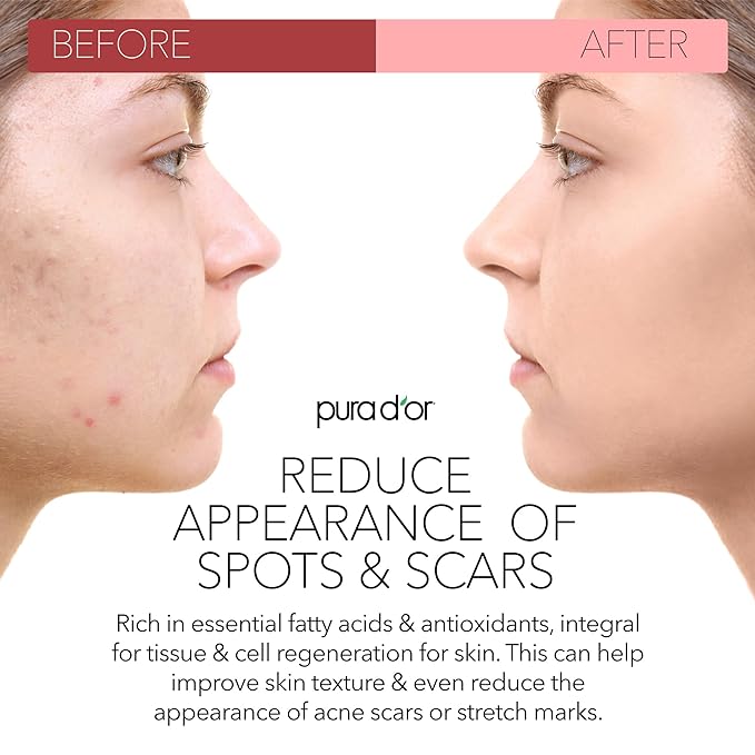 PURA D'OR ORGANIC Rosehip Seed Oil Hair Relaxer (4 Oz x3 = 12 Oz) 100% Pure Cold Pressed USDA Certified All Natural Anti-Aging, Scar Treatment, Gua Sha Massage, Face, Hair & Skin - Women & Men