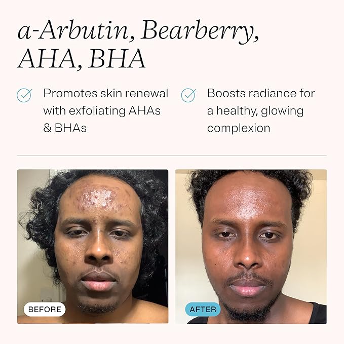 MDacne Dark Spot Remover For Face & Body, 40ml - Improves Skin Brightness, Texture & Tone, Oil-Free for Sensitive & Acne-Prone Skin, AHA & BHA Enhances Skin Radiance, 40 ml (Pack of 1)