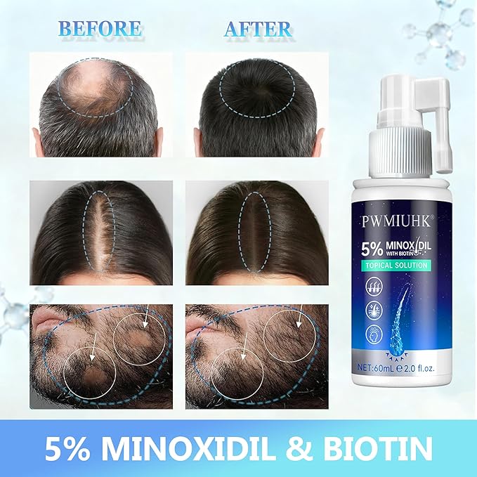 5% Minoxidil Hair Growth Spray - Minoxidil Spray Hair Regrowth Treatment Serum Stop Hair Thinning and Hair Loss For Stronger Thicker Longer Hair-2 fl.oz /60ml (2PCS)