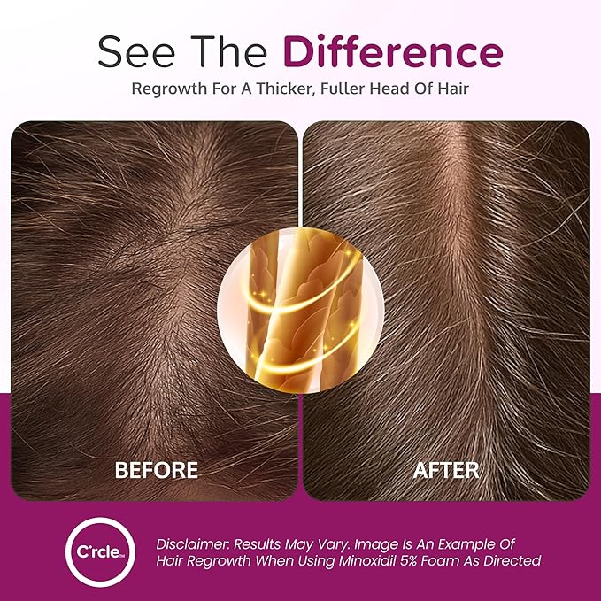 Minoxidil for Women 5% Foam - Helps Restore Top of Scalp Hair Loss and Support Hair Growth for Women, Regrowth with Unscented Topical Treatment for Thinning Hair (5% Foam 4-Month Supply)