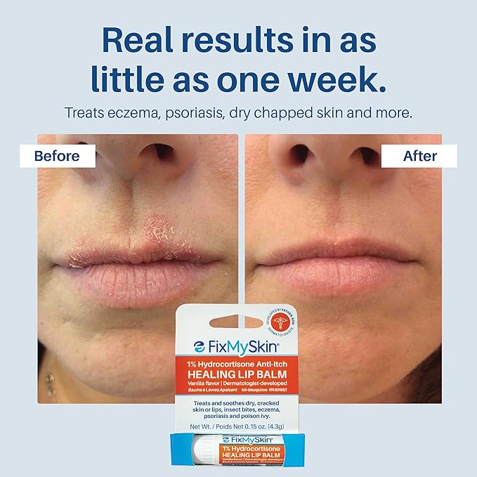 FixMySkin 1% Hydrocortisone Healing Lip Balm, Vanilla – Soothes Dry, Cracked & Irritated Lips, Relieves Chapped Lips, Cold Sores & Eczema, Dermatologist Developed, Travel-Friendly Tube, 0.15 oz