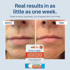 FixMySkin 1% Hydrocortisone Healing Lip Balm, Vanilla – Soothes Dry, Cracked & Irritated Lips, Relieves Chapped Lips, Cold Sores & Eczema, Dermatologist Developed, Travel-Friendly Tube, 0.15 oz