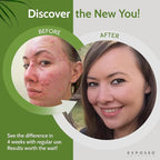 Exposed Skin Care, Expanded Acne Treatment Kit with 2.5% Salicylic Acid and 3.5% Benzoyl Peroxide to Clear Up Teen, Adult, Hormonal and Cystic Acne – Natural, Non-toxic and Cruelty Free