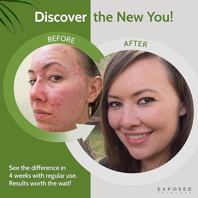 Exposed Skin Care, Expanded Acne Treatment Kit with 2.5% Salicylic Acid and 3.5% Benzoyl Peroxide to Clear Up Teen, Adult, Hormonal and Cystic Acne – Natural, Non-toxic and Cruelty Free