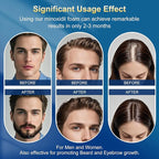 5% minoxidil foam for men-5pack， Infused with Biotin, Hair Growth Treatment, Supports Thicker and Fuller Hair & Beard (10.5oz, 5 Month Supply)