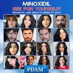 5% Minoxidil for Men and Women Foam Hair Growth - Minoxidil Foam Hair Regrowth Treatment for Men and Women, Topical Hair Loss Treatments, Extra Strength Thicker & Fuller Hair, 2 x 2.11 oz for 2 Months