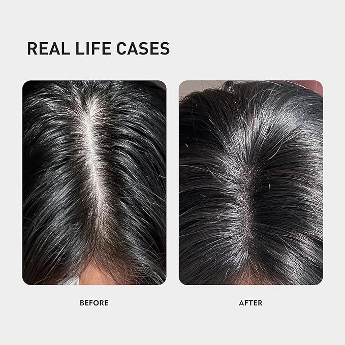 0.9% KX-826 KINTOR Hair Growth Spray,Strengthen Hair Nourish Hair follicles,Hair Care Products for Sparse Hair and Oily Hair Men&Women,180ml,Pro