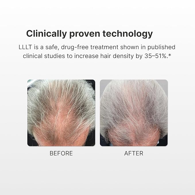 Hair Growth | Laser Hair Growth Products 276 Lasers 6 Minute Treatment FDA Cleared Drug-Free Comfortable Fit Lazer Hair Regrowth Hair Regrowth Lazer Treatment For Women