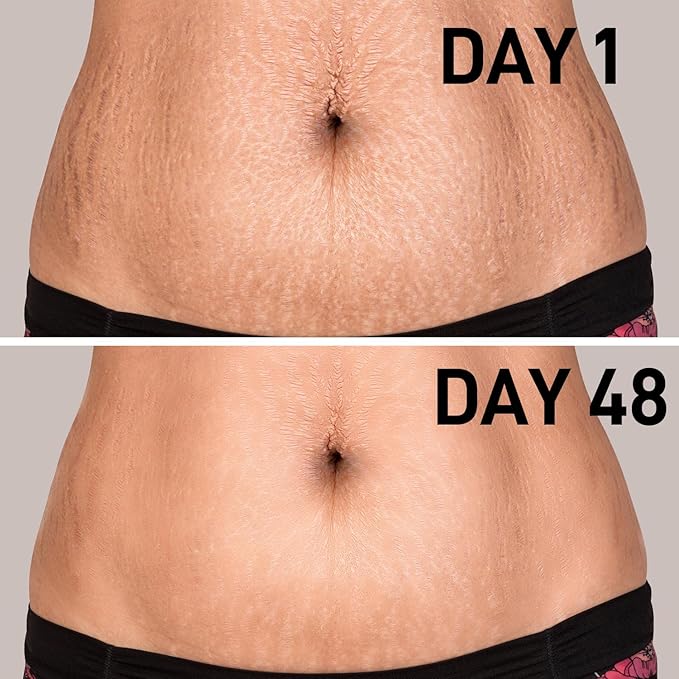 AOAO Stretch Mark Oil for Pregnancy and Body Oil for Pregnant Women, Morocco Nut Oil Help for Scars and Stretch Marks Removal and Prevention, Repair, Firming & Smoothing Fine Lines - 100ml/1pack