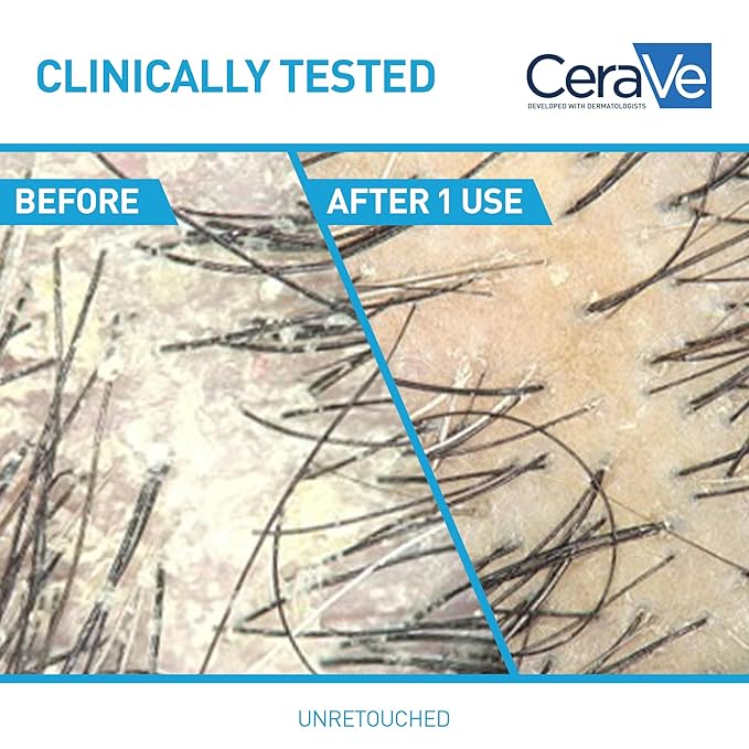 CeraVe Hydrating Anti Dandruff Conditioner, 0.5% Pyrithione Zinc Dandruff Treatment With Ceramides, Hyaluronic Acid & Niacinamide, Helps Eliminate Flakes & Reduce Itchy Scalp, Sulfate Free Conditioner