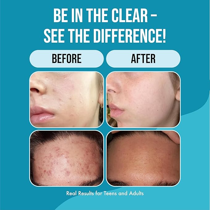 Teenology Teen Shampoo – Avoid Acne Breakouts, Non-Comedogenic, For Dry & Oily Scalps, Sulfate & Paraben Free, Natural Extracts, for Clear Skin & Healthy Hair, 16 oz – (Blueberry Pomegranate Cucumber)