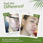 Exposed Skin Care, Acne Treatment Serum with 3.5% Benzoyl Peroxide – Lightweight Acne Spot Treatment – Quickly Clear Teen, Adult, Hormonal and Cystic Acne – Natural, Non-toxic and Cruelty Free