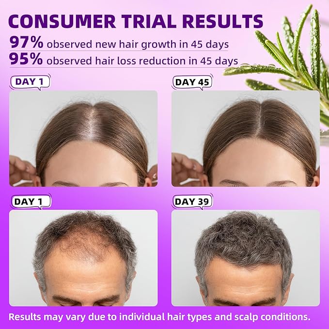 5% Minoxidil for Men and Women Hair Growth Products, Biotin Serum with Rosemary for Hair Regrowth Treatment, Minoxidil Spray Extra Strength Hair Loss Solution, Clinically Proven to Regrow Thicker