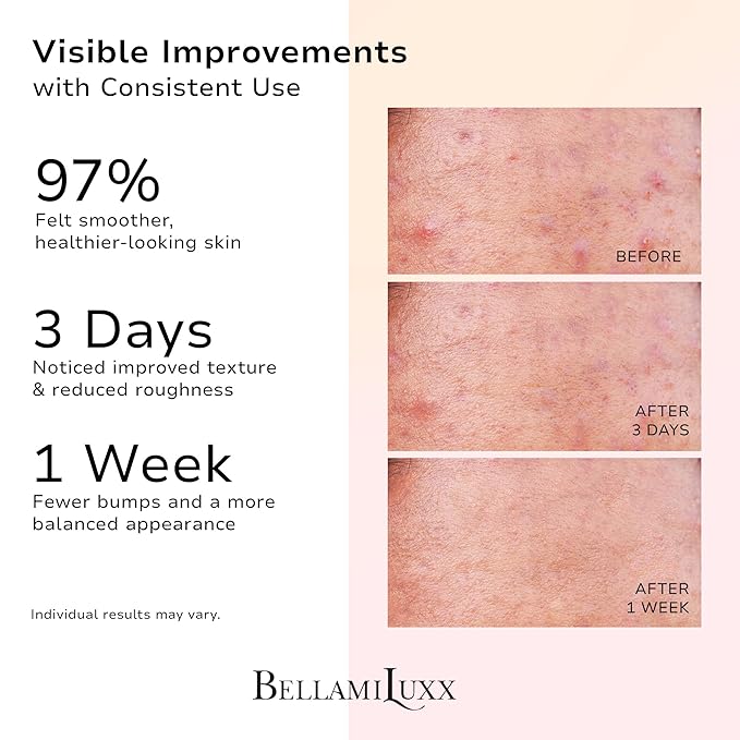 Butt Acne Clearing Set: Butt Acne Lotion + Acne Soap + Body Acne Scrub for Breakouts on Butt, Thighs, Back & Chest, KP Bumps, Clogged Pores & Rough Buttocks – Exfoliate, Cleanse & Smooth