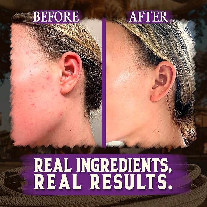 Organic Beef Tallow for Skin - 4 OZ (Lavender) — Grass Fed Beef Tallow for face + Body — US-Made Whipped Tallow and Honey Balm Moisturizer for Dry and Sensitive Skin, Eczema, Rosacea (No Additives)