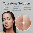 QRxLabs Salicylic & Glycolic Acid Pads (2% Salicylic & 10% Glycolic) - Acne Pads for Face & Bacne with Vitamins B5, C & E, Calendula & Green Tea - Face Exfoliator - 50 Count Jar