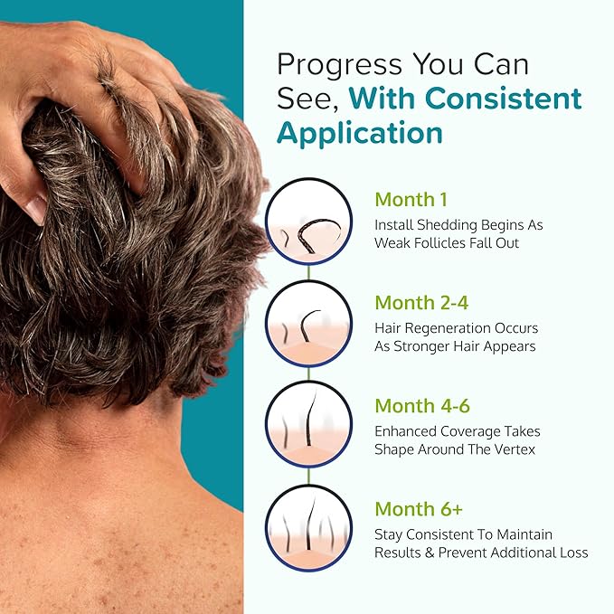 Minoxidil for Men Foam 5% - Unscented 6 Month Supply - Helps Restore Vertex Hair Loss & Thinning - 5% Minoxidil Foam For Men - Extra Strength Supports Hair Regrowth