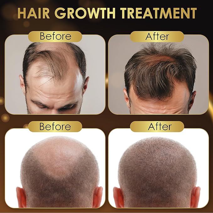 Elevate Hair Regrowth Treatment 5% Minoxidil Solution for Hair Growth - Extra Strength Topical Hair Growth Serum for Thicker, Fuller Hair 2 Fl Oz Made in USA