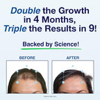 Patented Hair Growth Vitamins for Women & Men | Clinically Proven Hair Loss Supplement for Visibly Thicker Fuller Hair | Dr. Recommended Hair Vitamins for Hair Loss and Thinning | 4 Month Supply