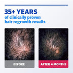 Men's Rogaine Extra Strength 5% Minoxidil Topical Solution for Hair Loss & Regrowth, Topical Treatment for Men, Unscented Minoxidil Follicle Booster Liquid, 1-Month Supply, 2 fl. oz