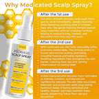 Psoriasis Scalp Spray | Psoriasis and Dandruff Treatment for Scalp Yeast Infections, Psoriasis Flare-Ups & Folliculitis | Antifungal Ringworm Itchy Scalp Spray for Psoriasis, Dryness