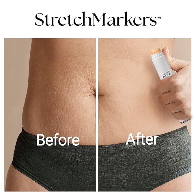 StretchMarkers Therapy Stretch Mark Cream – Visibly Reduces and Treats, Stretch Marks Removal with Retinol, Hyaluronic Acid, Bioactive Peptides & 3D Stem Cell Technology, 1 fl oz