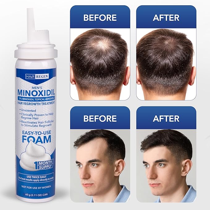 Minoxidil Foam for Men 5% Percent - Men's Hair Growth Treatment for Him- Topical Foaming Minoxidil for Men- Great for Hair Regrowth and Reduce Hair Loss - 6 Pack as 6 Months Supply